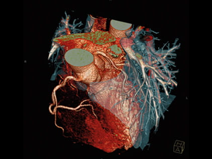 Image capture from the SOMATOMĀ® Definition Flash which allows for a more accurate diagnosis.
